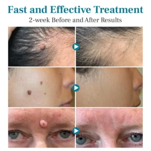NEWYUO® Non-invasive Mole and Wart Removal Laser Pen 🟢1