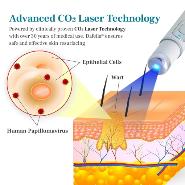 NEWYUO® Non-invasive Mole and Wart Removal Laser Pen 🟢1