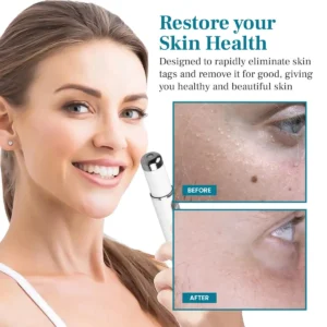 NEWYUO® Non-invasive Mole and Wart Removal Laser Pen 🟢1