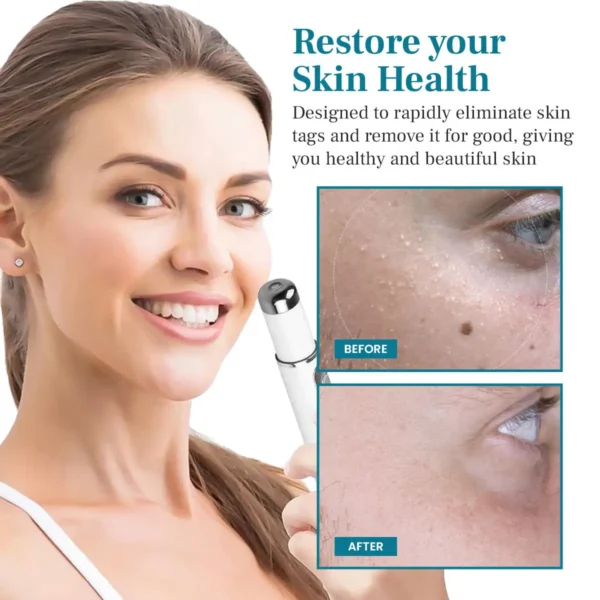 NEWYUO® Non-invasive Mole and Wart Removal Laser Pen 🟢1
