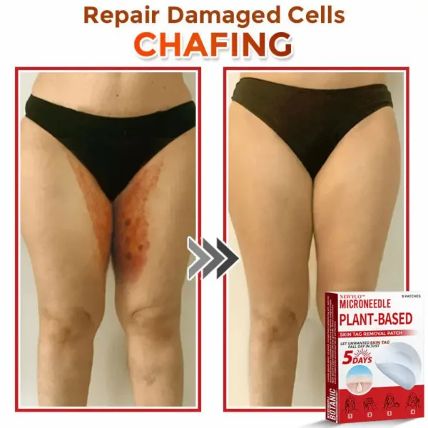 Newyuo® MicroNeedle Botanic Skin Tag Removal Patch