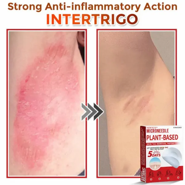 Newyuo® MicroNeedle Botanic Skin Tag Removal Patch