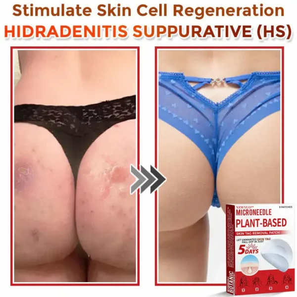 Newyuo® MicroNeedle Botanic Skin Tag Removal Patch