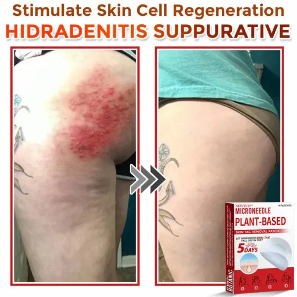 Newyuo® MicroNeedle Botanic Skin Tag Removal Patch