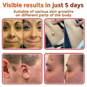 Newyuo® MicroNeedle Botanic Skin Tag Removal Patch