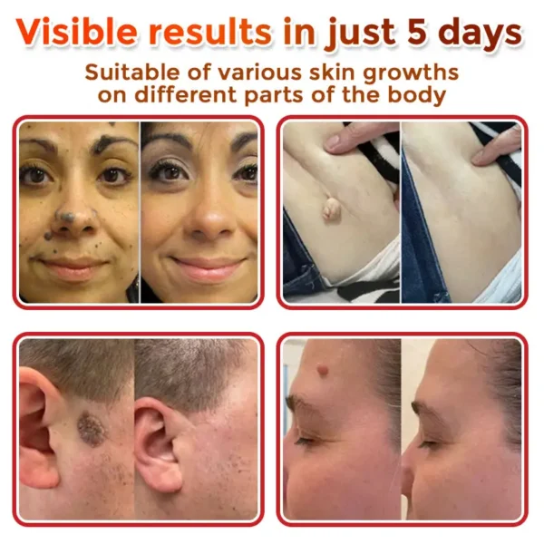 Newyuo® MicroNeedle Botanic Skin Tag Removal Patch