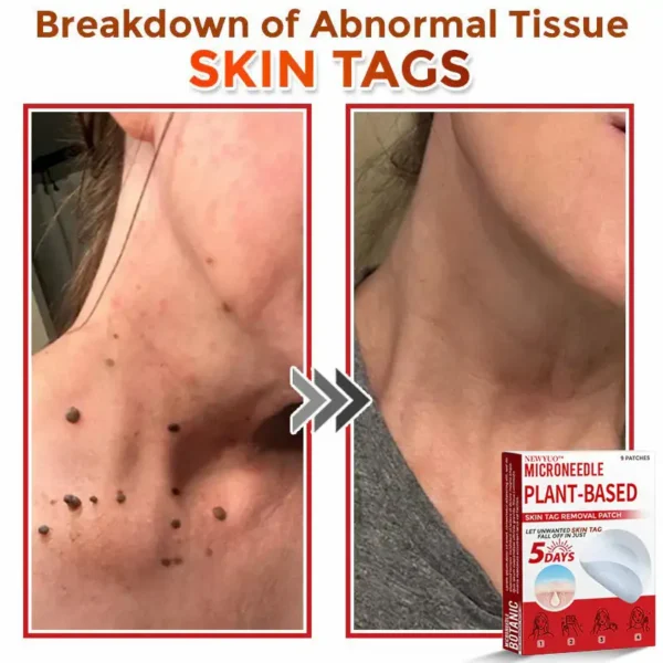 Newyuo® MicroNeedle Botanic Skin Tag Removal Patch