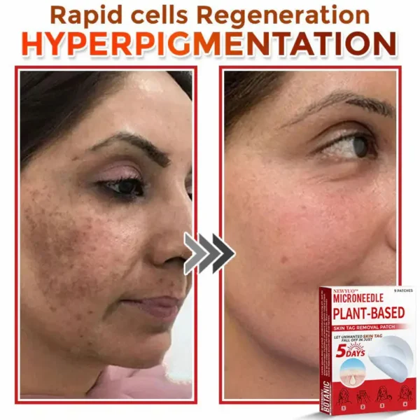 Newyuo® MicroNeedle Botanic Skin Tag Removal Patch