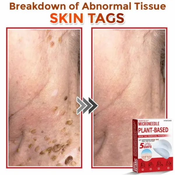 Newyuo® MicroNeedle Botanic Skin Tag Removal Patch