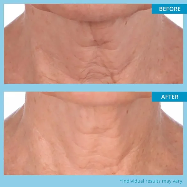 Newyuo™ Neck & Décolleté Firming Mask – Visible Lift While You Sleep