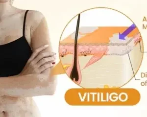 Newyuo® VitiCalm Bee Venom Cream