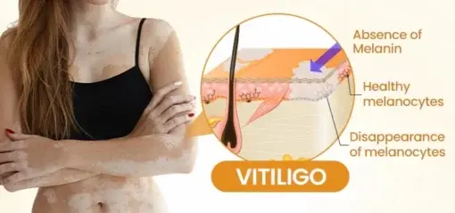 Newyuo® VitiCalm Bee Venom Cream