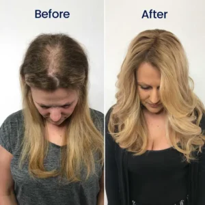 Newyuo® Maximum Strength 5% Minoxidil Fast-Action Hair Growth Serum