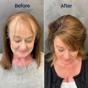 Newyuo® Maximum Strength 5% Minoxidil Fast-Action Hair Growth Serum