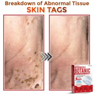 🌈Newyuo™ MicroNeedle Botanic Skin Tag Removal Patch 🇺🇸 Made in the USA