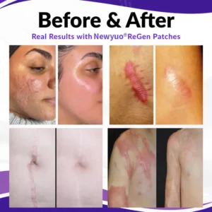 Newyuo® ReGen Microneedles Pro Patches Scar & Skin Repair