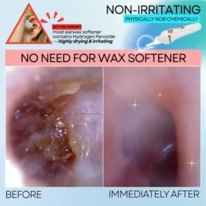 Newyuo® Electric Ear Wax Vacuum Cleaner – Safe, Quiet & Effective 👂✨