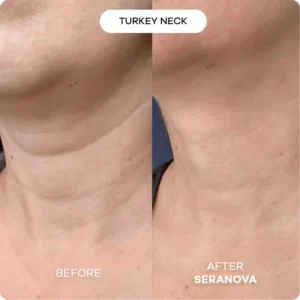 Newyuo® hydrating, moisturizing, anti-wrinkle, firming micro needles