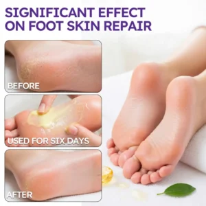 🎁 NEWYUO™ Limited-Time Offer 🎁 - Don't miss out!Tea Tree Oil Foot Cream (Repairs Dry Cracked Heels, Soothes Tired Feet, Eliminates Odor & Restores Soft Skin)